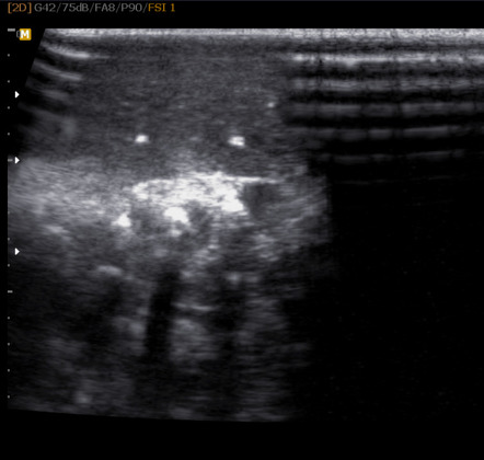 Chronic hereditary lymphedema | Image | Radiopaedia.org