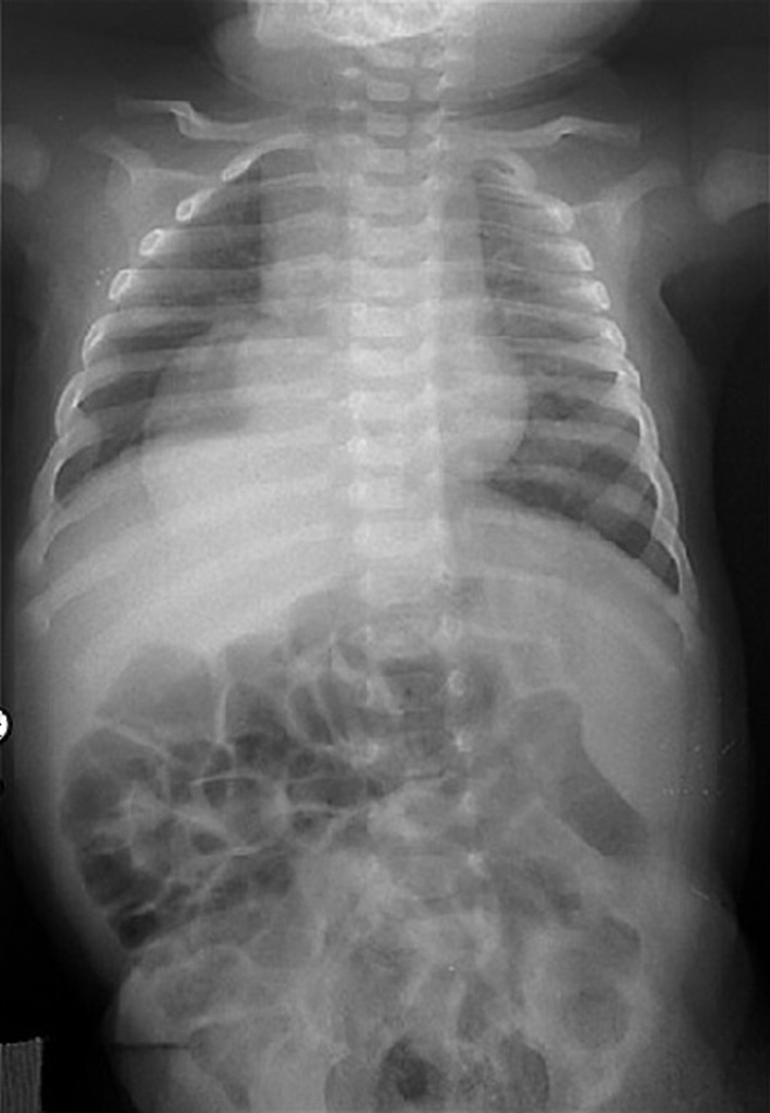 Ectopic Thoracic Kidney Radiology Case Radiopaedia Org