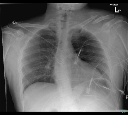 Subclavian artery traumatic injury | Radiology Case | Radiopaedia.org