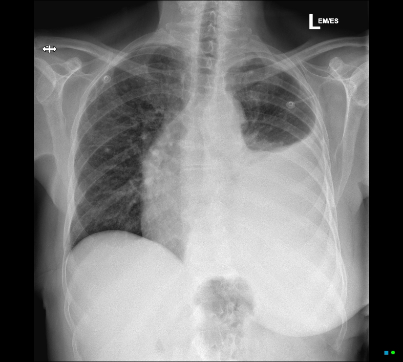 Malignant Pleural Effusion Image Radiopaedia Org