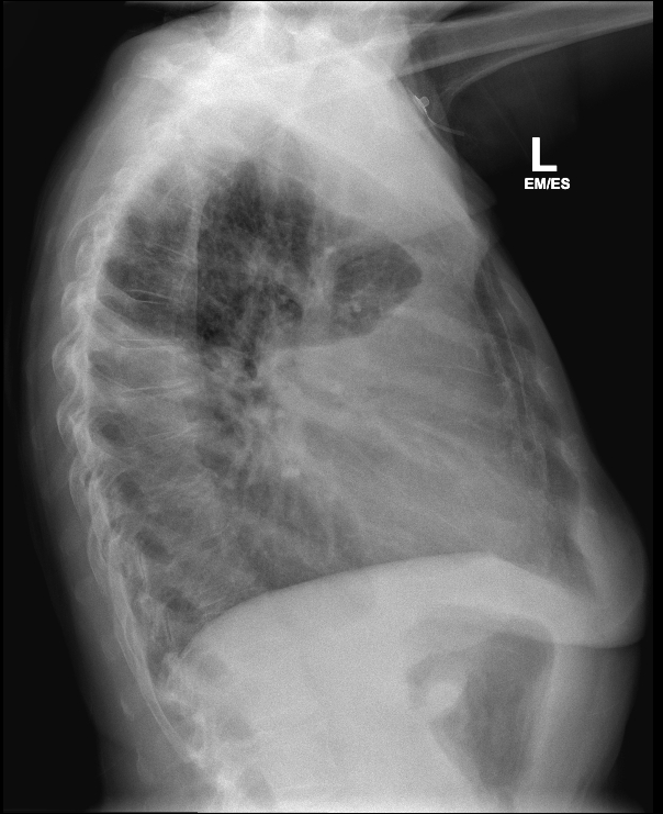 Malignant Pleural Effusion Image Radiopaedia Org