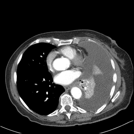 Malignant pleural effusion | Image | Radiopaedia.org