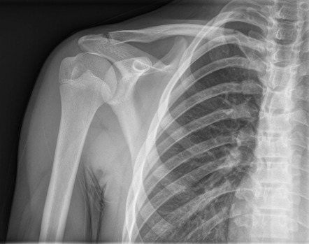 Medial clavicle fracture | Radiology Case | Radiopaedia.org