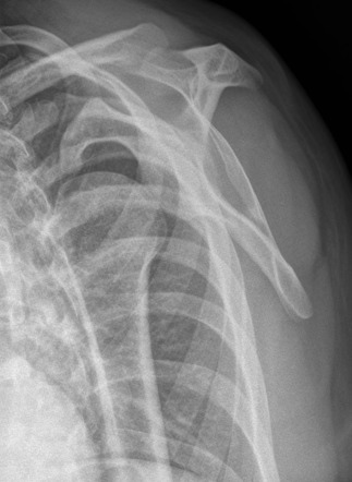 Anterior glenohumeral joint dislocation | Radiology Case | Radiopaedia.org