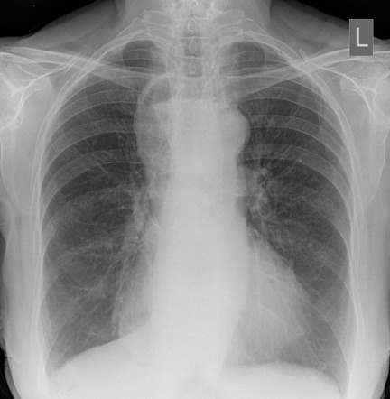 Achalasia | Radiology Case | Radiopaedia.org