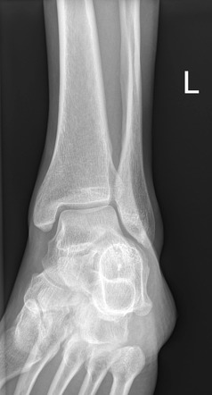 Normal ankle (radiograph) | Radiology Case | Radiopaedia.org