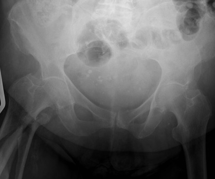 Right proximal femur fracture | Radiology Case | Radiopaedia.org