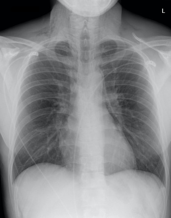 Pneumomediastinum | Radiology Case | Radiopaedia.org