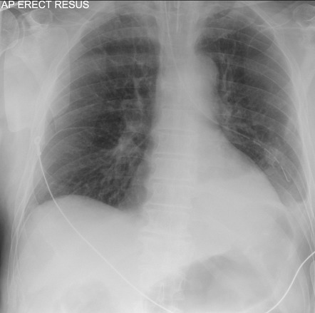 Nasogastric tube positioning | Radiology Reference Article ...