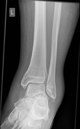 Displaced fibula tip avulsion fracture Radiology Case