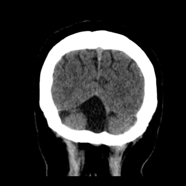 Mega cisterna magna | Image | Radiopaedia.org