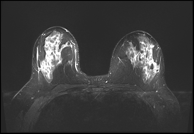 Normal Breast MRI - Dense Breasts | Image | Radiopaedia.org