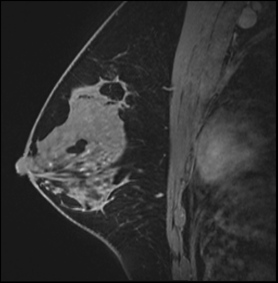 Normal breast MRI (dense breasts) Image