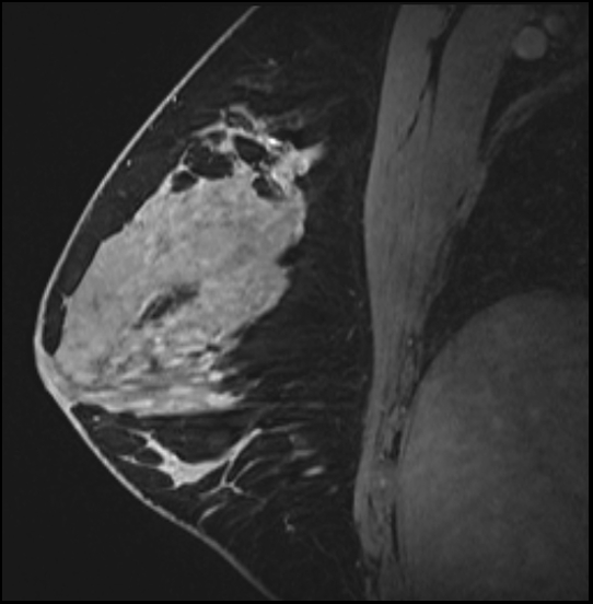 Normal Breast Mri Dense Breasts Image 8081