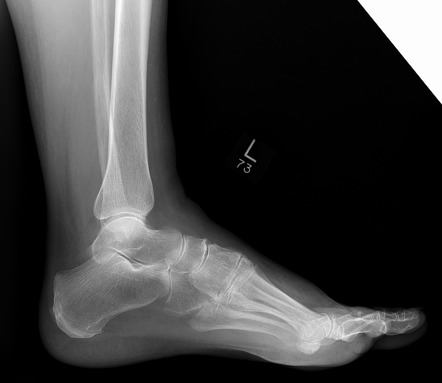 Chopart injury | Image | Radiopaedia.org