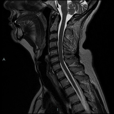 Parotid liposubstitution | Image | Radiopaedia.org