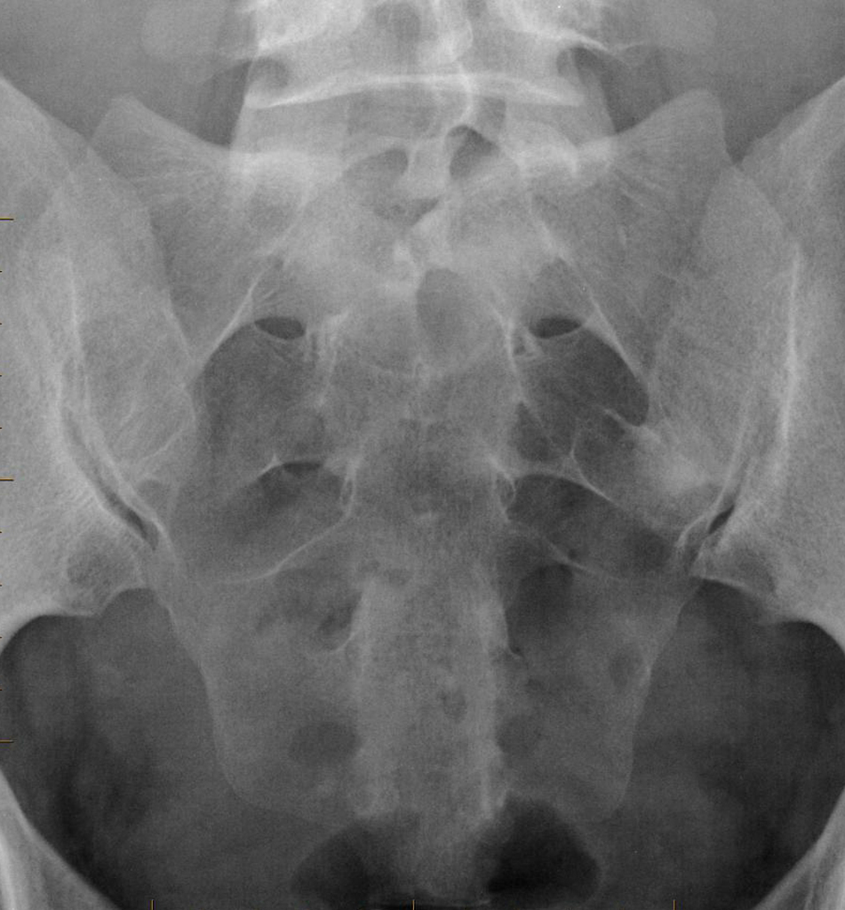 sacrum anatomy xray