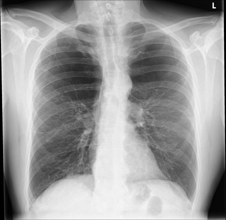 Pulmonary Emphysema X Ray