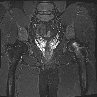 Subchondral insufficiency fracture - femoral head | Image | Radiopaedia.org