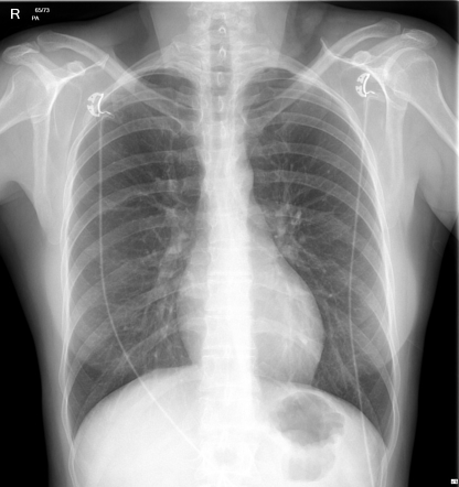 Normal chest (radiograph) | Radiology Case | Radiopaedia.org