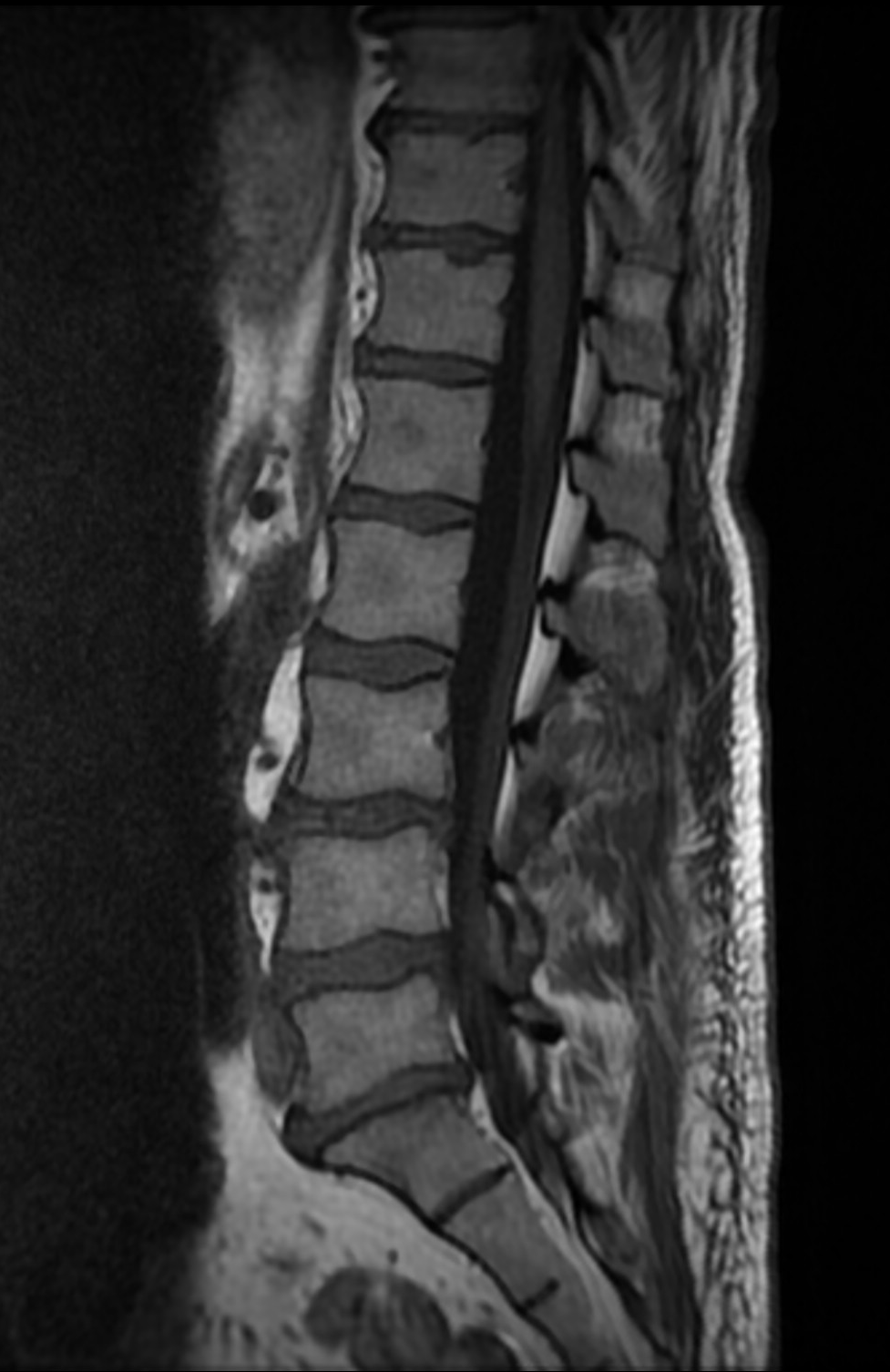 Foraminal disc prolapse | Image | Radiopaedia.org