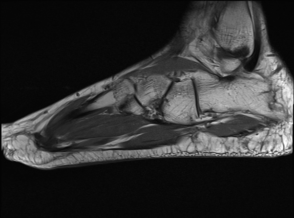 Plantar fibromatosis | Image | Radiopaedia.org