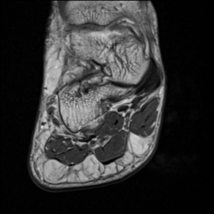 Fibroma Fibromatosis Fibromyxoma Myxofibroma