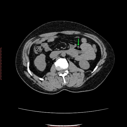 Left paraduodenal internal hernia | Image | Radiopaedia.org