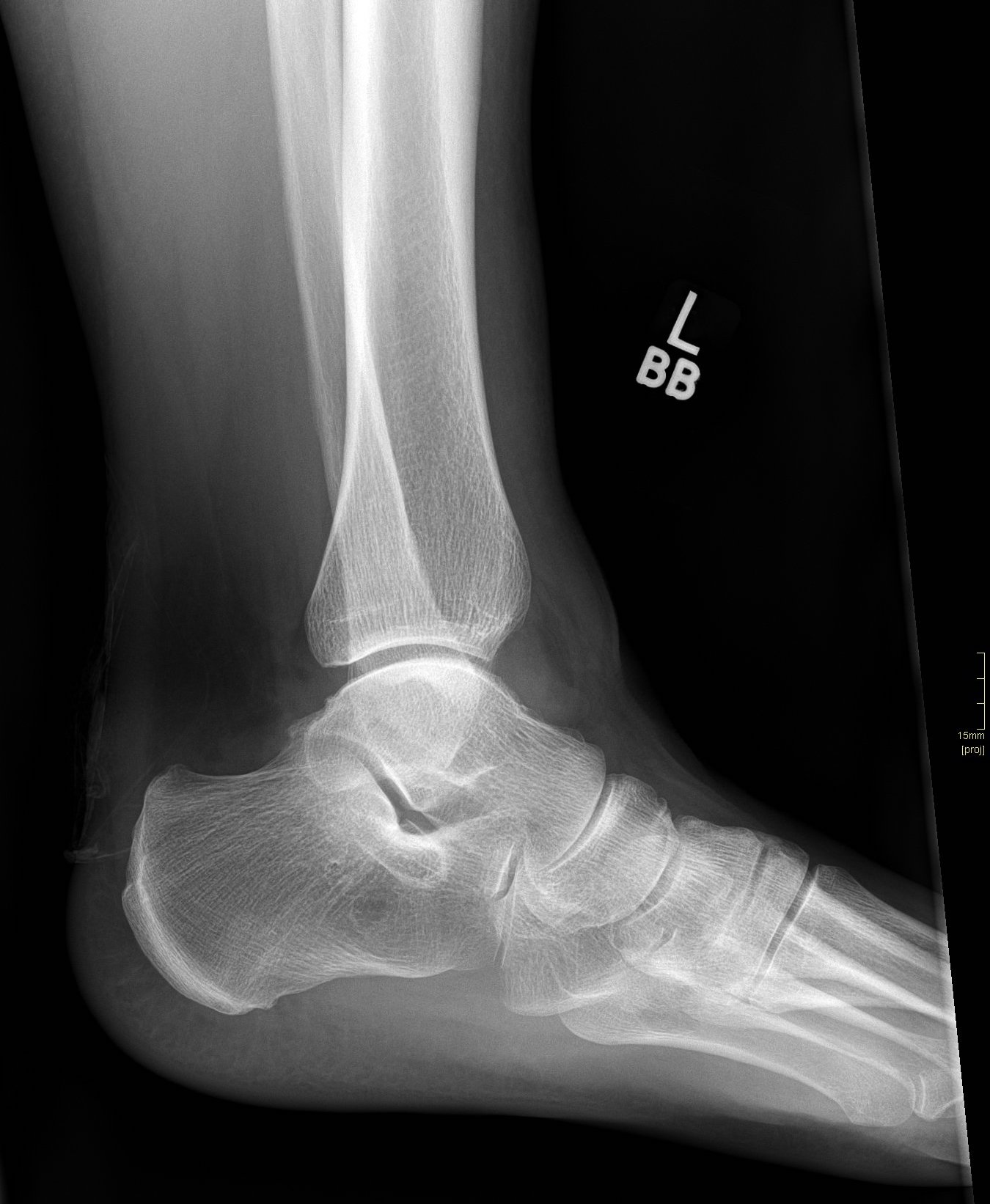 Chaput tubercle fracture | Image | Radiopaedia.org