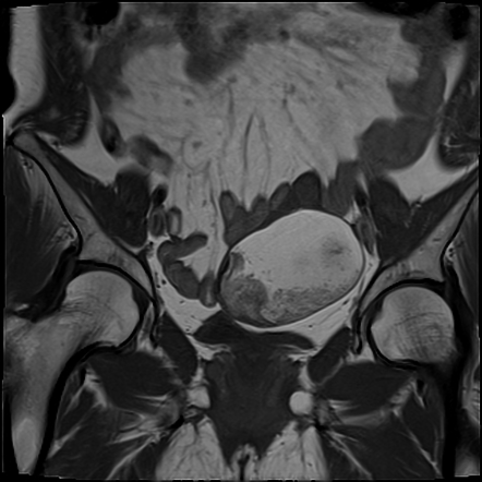 Ovarian dermoid cyst | Radiology Case | Radiopaedia.org