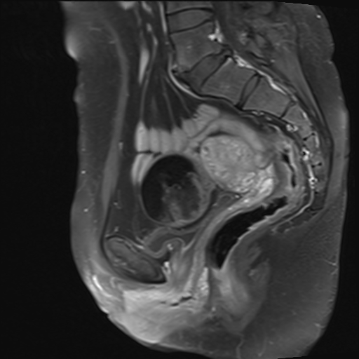 Ovarian dermoid cyst | Image | Radiopaedia.org