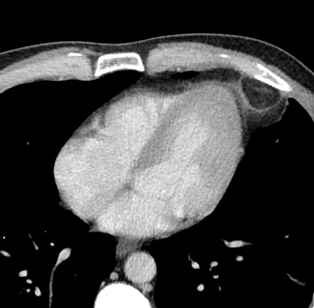 Epipericardial fat necrosis | Radiology Case | Radiopaedia.org