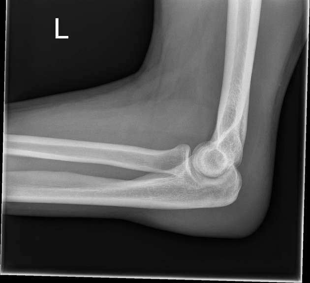 Elbow (lateral view) | Radiology Reference Article | Radiopaedia.org