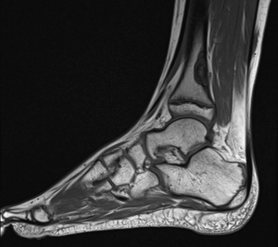 Non-ossifying fibroma of distal tibia | Image | Radiopaedia.org