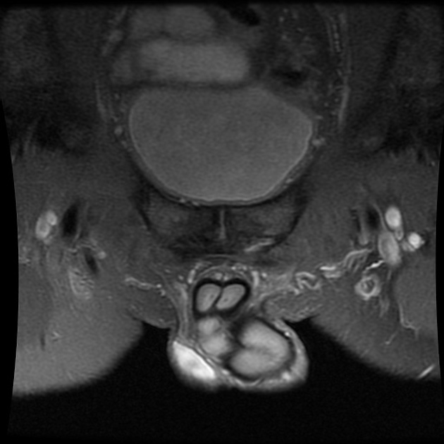 Athletic Pubalgia Mechanism of Injury - El Paso, TX Doctor Of