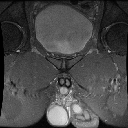 Rectus abdominus-adductor longus aponeurosis tear - superior cleft sign ...