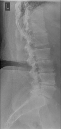 Discitis/osteomyelitis (radiograph) | Radiology Case | Radiopaedia.org