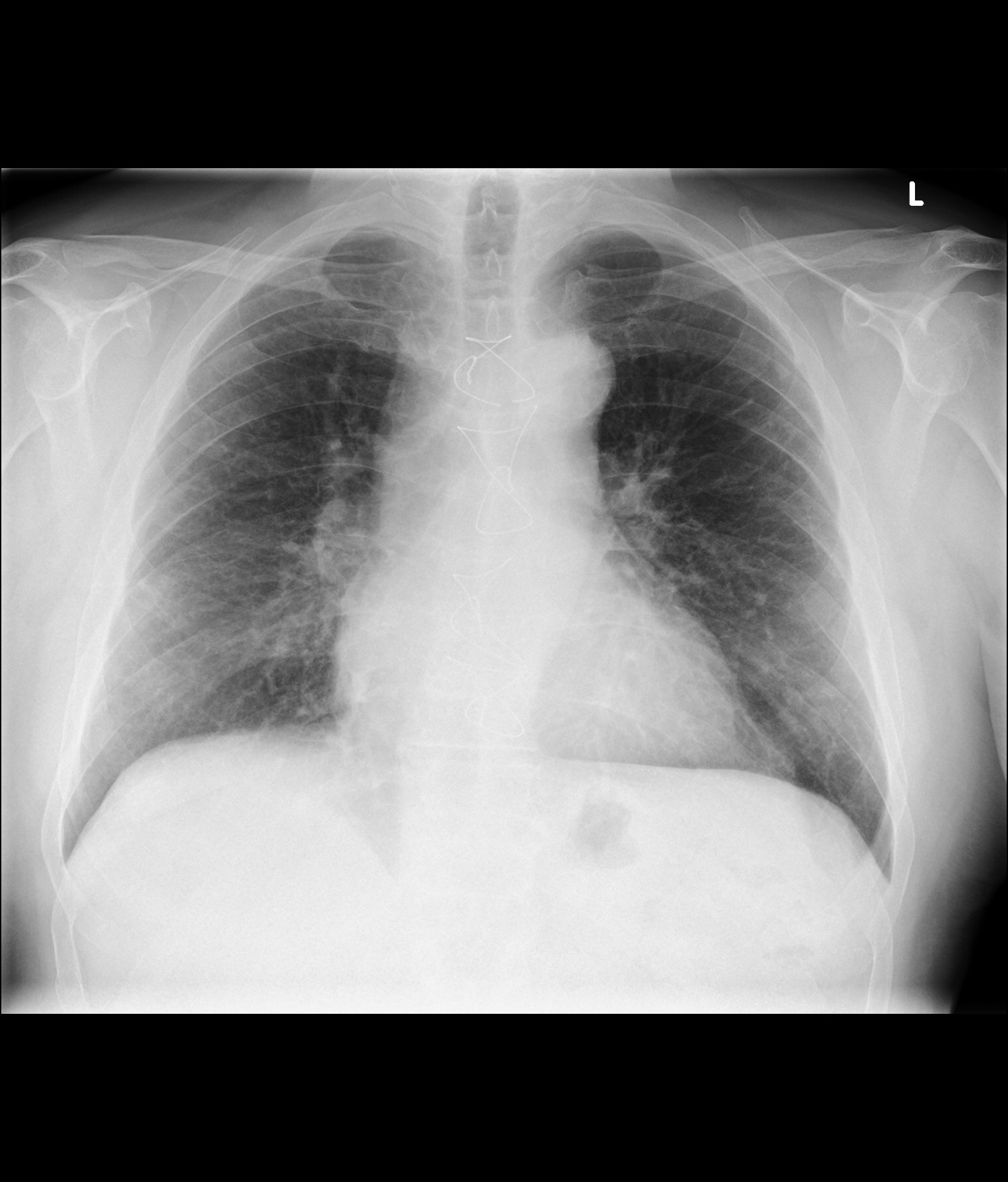 covid-pneumonia-and-recovery-image-radiopaedia