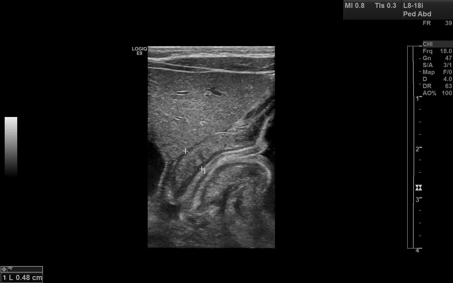 Hypertrophic Pyloric Stenosis Image 9977