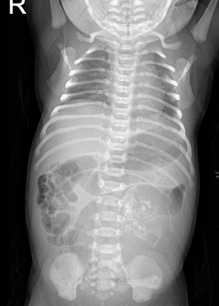 Fetus in fetu | Radiology Case | Radiopaedia.org