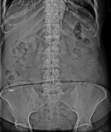 Porcelain gallbladder | Radiology Case | Radiopaedia.org