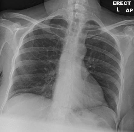 Pneumoperitoneum - rapids exam | Radiology Case | Radiopaedia.org