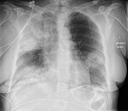 Legionella pneumonia | Radiology Reference Article | Radiopaedia.org