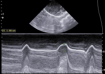 Unilateral diaphragmatic paralysis in new born, Radiology Case