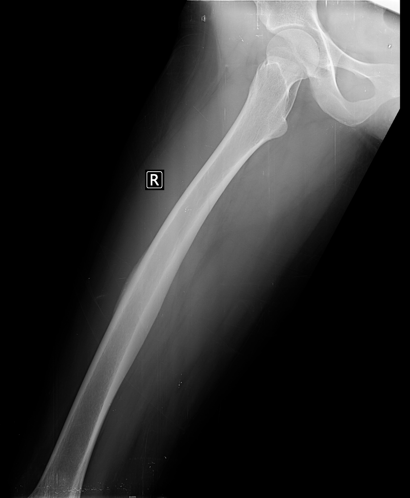 osteoid osteoma femur