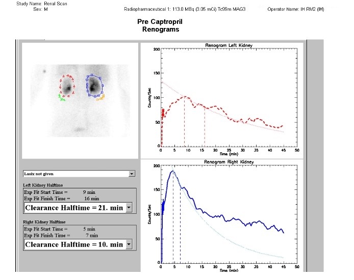 Renal artery stenosis on captopril renal MAG3 nuclear study | Image ...