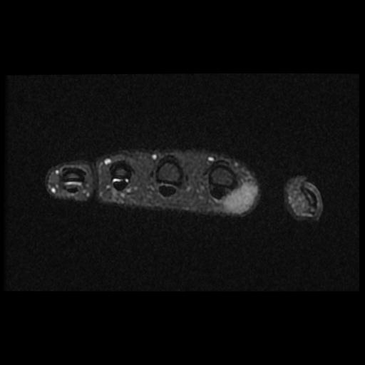 Tenosynovial Giant Cell Tumor Index Finger Image