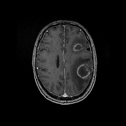 Primary Central Nervous System Posttransplant Lymphoproliferative ...