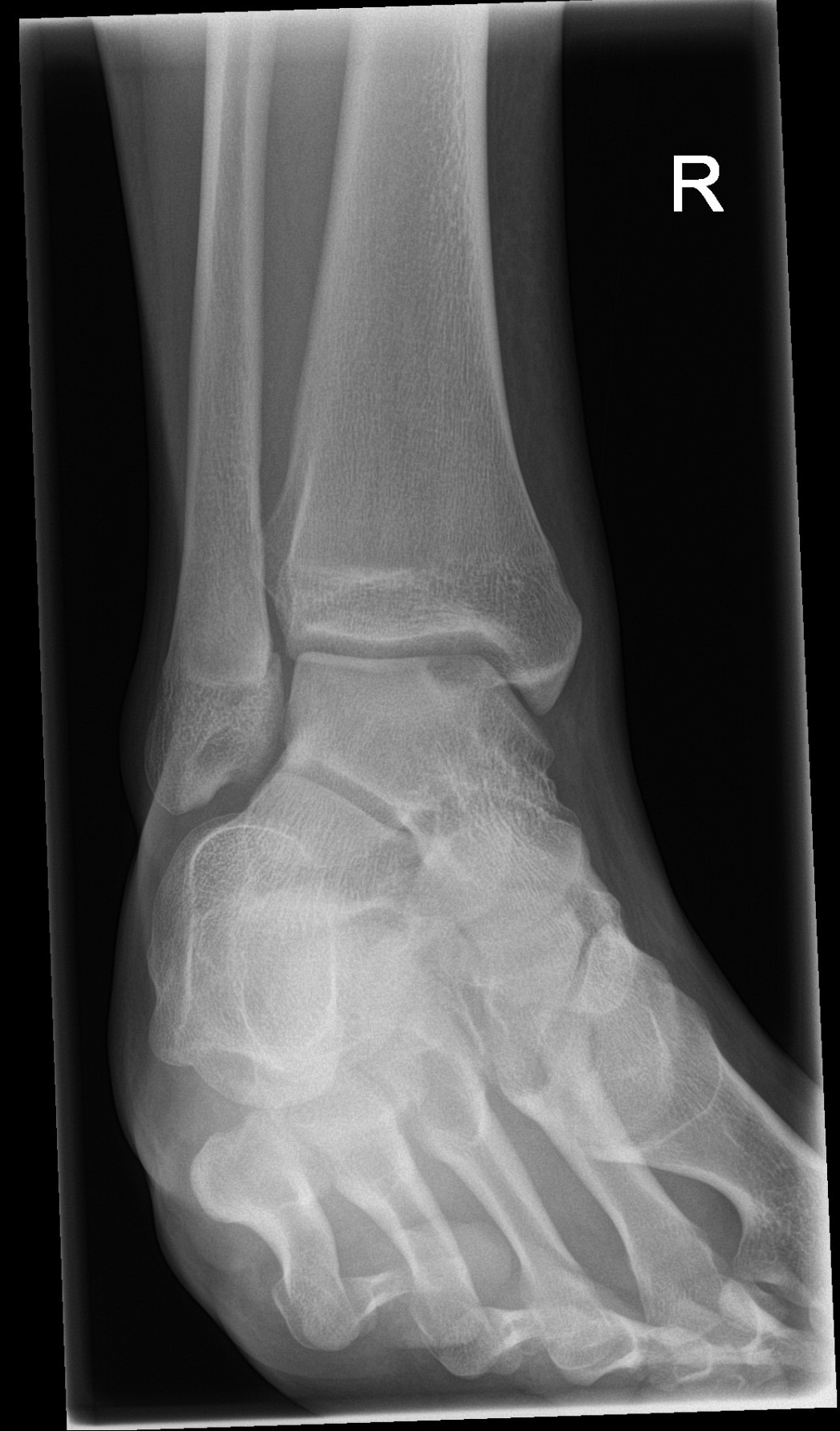 Osteochondral defect | Image | Radiopaedia.org