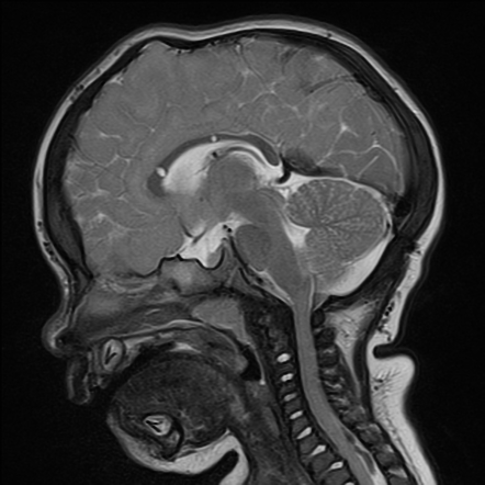 Mucopolysaccharidoses | Image | Radiopaedia.org